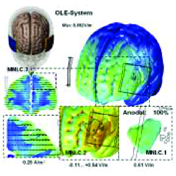 tDCS - ETCD